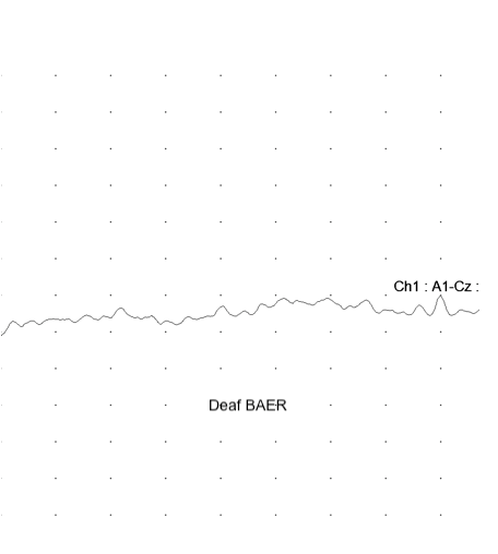 BAER Deaf Graph