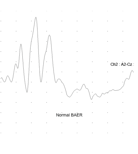 BAER Normal Graph